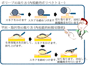 ポリープの取り方